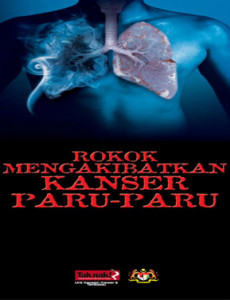 Merokok mengakibatkan kanser paru-paru (B. Malaysia)